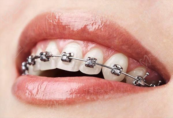 2021年牙科收费价目表大全!做种植牙,牙齿矫正一定要收藏!