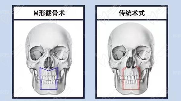 正颌直术比正颌手术会影响手术成效吗