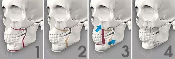 正颌直术的具体口腔条件