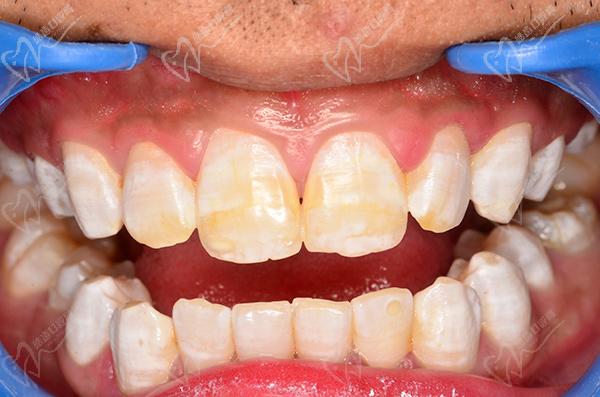 氟斑牙是什么牙