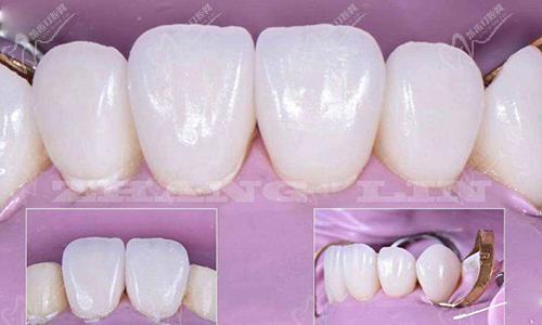 氟斑牙蕞佳治疗方式