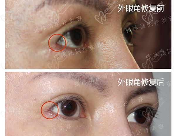 张冰洁外眼角修复案 例图：外眼角术后粘连