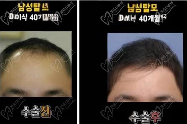 韩国布莱克植发医院病例