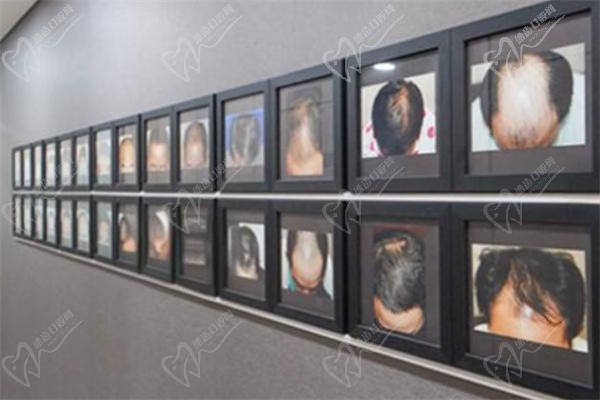 韩国布莱克植发医院展示