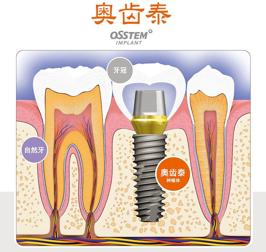 韩国奥齿泰osstem种植牙