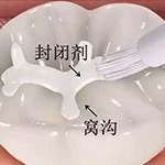窝沟封闭