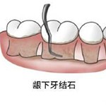 龈下刮治