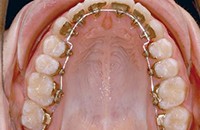 舌侧隐形矫正效果图