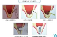 上颌窦提升术