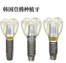 宁夏银川诺贝尔口腔韩国登腾种植牙套餐3999元起，性价比超高看过来