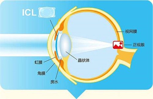 济南麦迪格眼科晶体植入价格29600起,定制近视方案视觉质量高