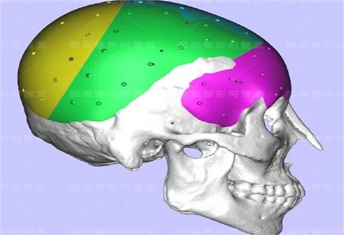 上海时光何晋龙peek填后脑勺价格8W-10W起，3D打印很贴合没有异物不适感