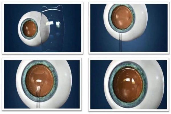 武汉佰视佳眼科icl晶体植入25600元起-周跃明院长专做近视手术