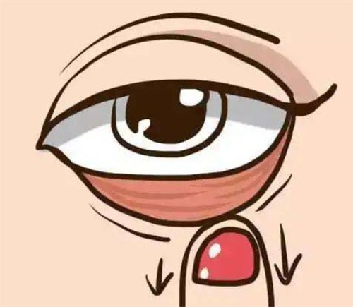 武汉江城整形外科医院做下睑修复价格6000+,王志医生亲诊解决下睑外翻