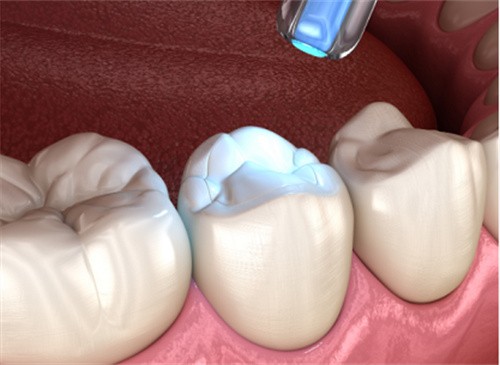   南充莱丁堡口腔门诊部汤鑫贇树脂补牙198元起，地址电话价格表全都有