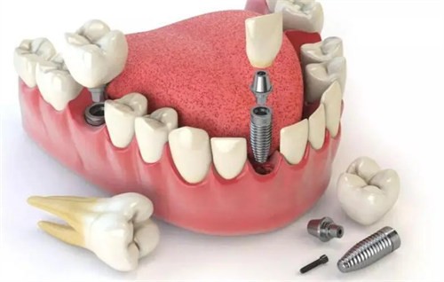 西安小白兔口腔韩国登腾种植牙3880起，选肖新医生技术靠谱
