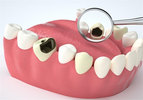 杭州雅莱口腔成人Z350树脂补牙单颗价格256元起,刘一璇医生补牙技术好