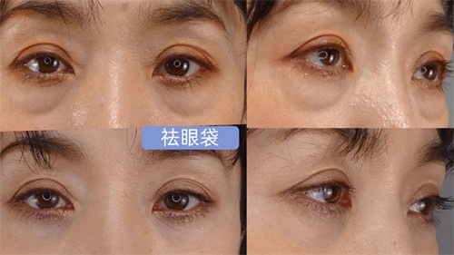 西安画美整形医院张莎莎祛眼袋精雕细琢，价格低至2800元起
