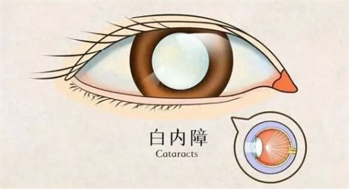 镇江康复眼科擅长各种复杂眼病治疗，石春和医生做白内障手术价格5k+