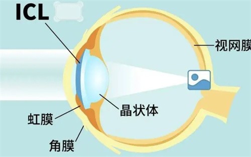 镇江康复眼科可以做高度近视矫正，石春和医生亲诊ICL晶体植入价格31000起