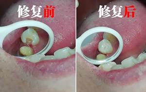 补牙 补牙