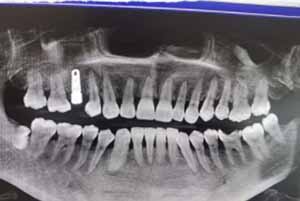 武汉萌芽齿科牙片 武汉萌芽齿科牙片