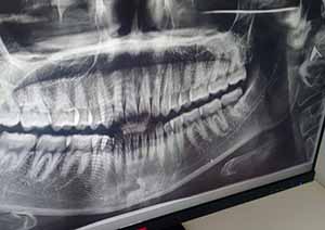 德州大美口腔门诊牙片 德州大美口腔门诊牙片