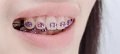 连云港灌云美欣口腔门诊部牙齿矫正反馈 连云港灌云美欣口腔门诊部牙齿矫正反馈