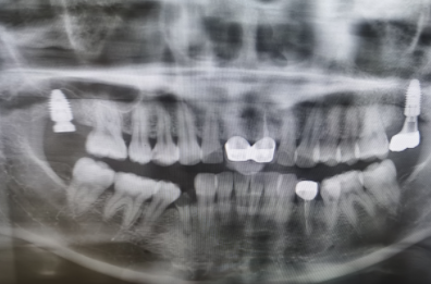 盐城倍美永康口腔吕利松种植牙 盐城倍美永康口腔吕利松种植牙