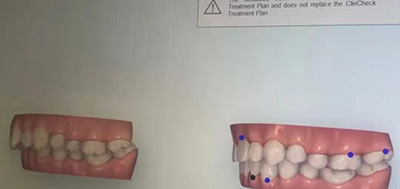 义乌德康口腔门诊部牙齿矫正模拟图