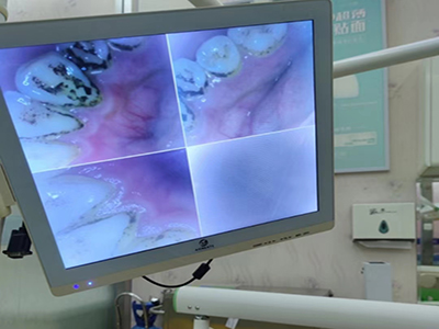 牙齿色素沉着 牙齿色素沉着