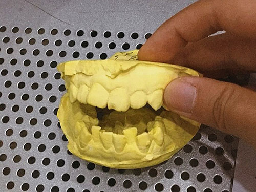 牙齿矫正牙模