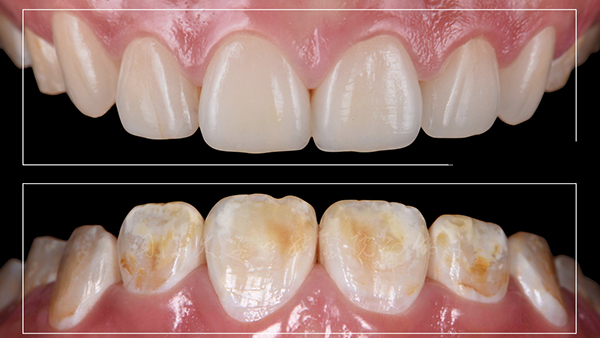 昆明泰康拜博口腔医院全口超薄瓷贴面 昆明泰康拜博口腔医院全口超薄瓷贴面