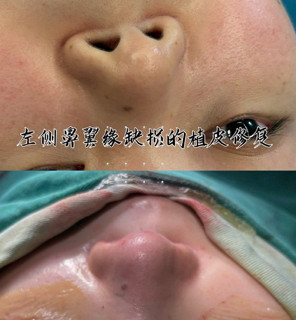 艺星整形医院进行的肋软骨隆鼻修复 艺星整形医院进行的肋软骨隆鼻修复