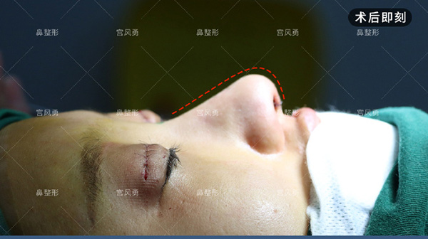 宫风勇做鼻子的个人体验分享