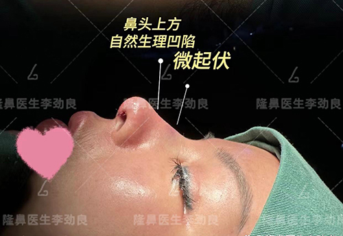 李劲良医生的鼻修复+眉弓+脂肪加减法手术
