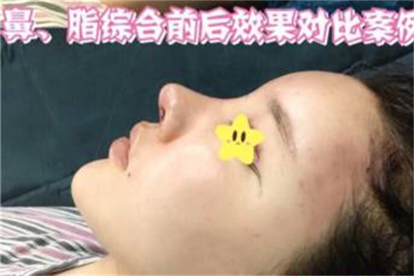 泰国曼谷雨整形医院病例