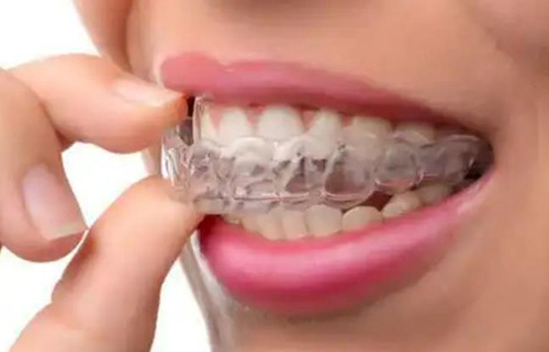 隐形矫正图片 隐形矫正图片