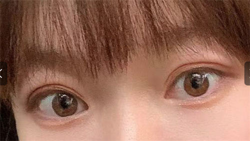 双眼皮22.jpg