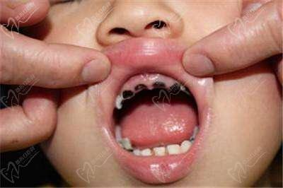 儿童急性龋恶化上切牙乳牙坏死