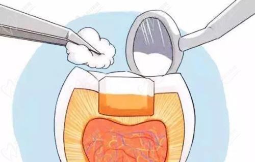 补牙操作图