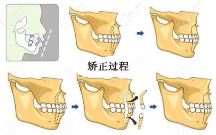 做完种植牙还可以做牙齿矫正吗？看北京中诺口腔刘忠祥的解答！