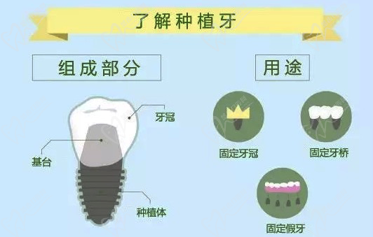 种植牙种植体结构图
