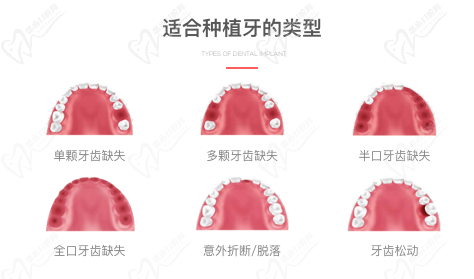 适合种植牙的类型