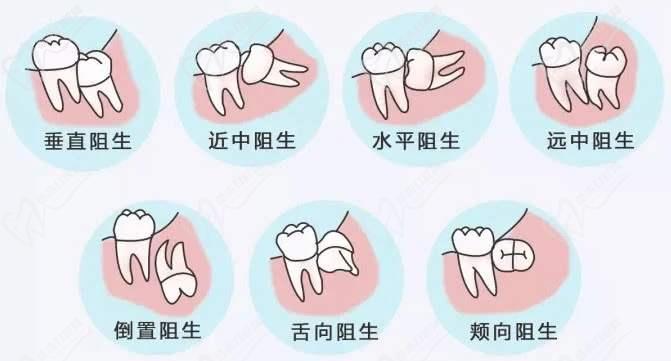 智齿种类