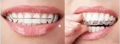 牙齿保持器