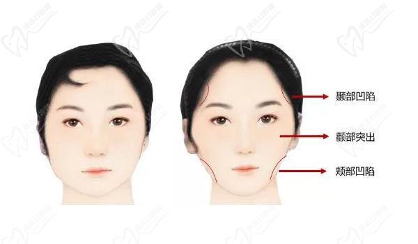牙套脸