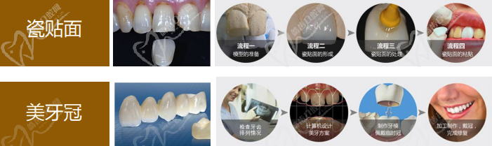 贴面和美牙冠流程