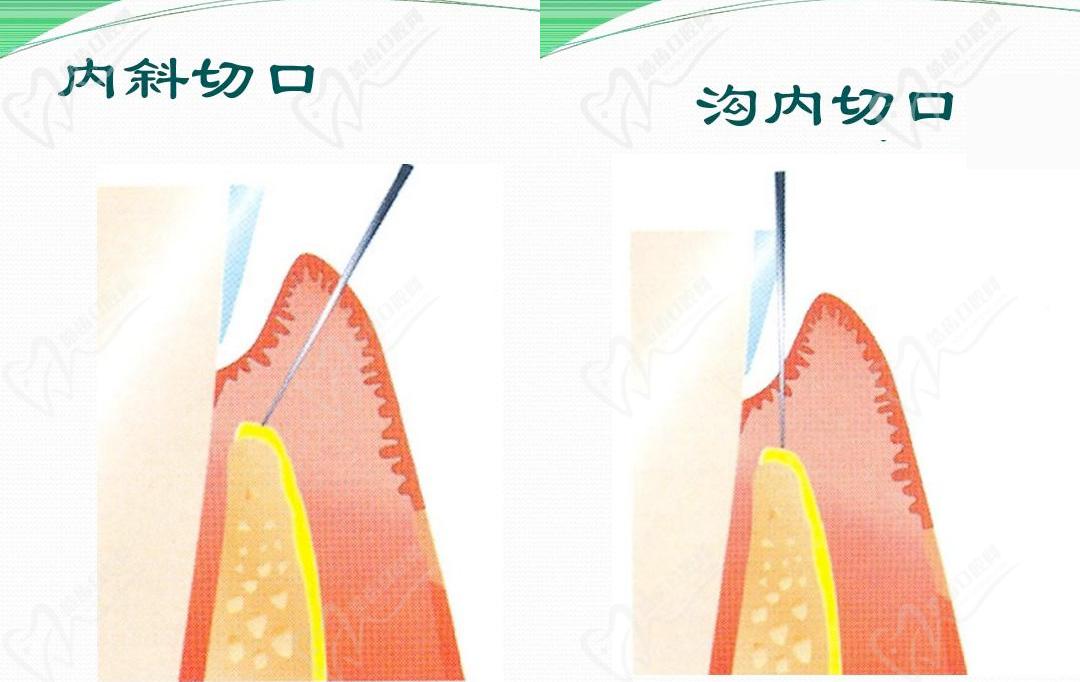 龈瓣切除术图解图片