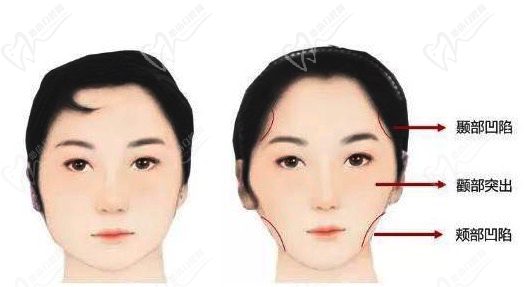 牙套脸怎么办？